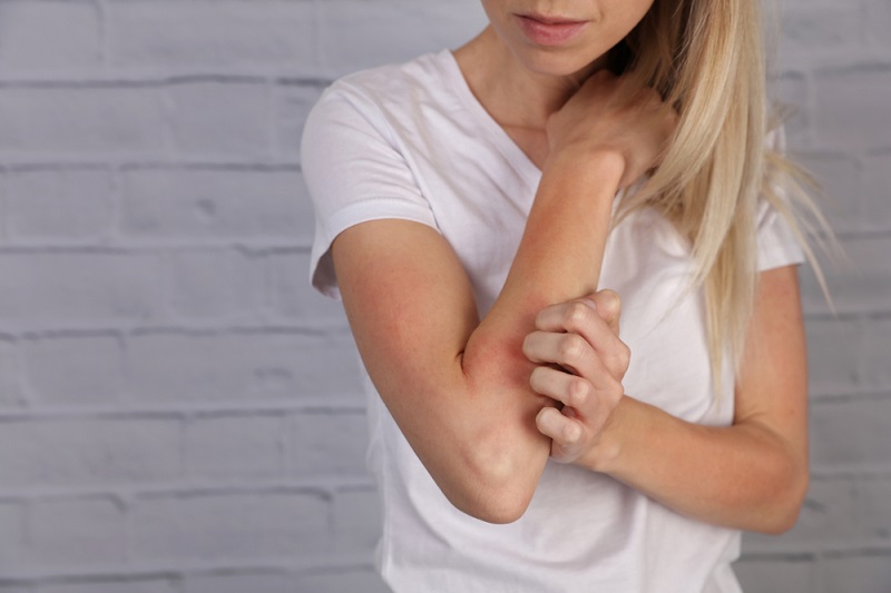 5 Tips For Avoiding Eczema Flares